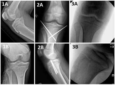 Type 4 Tibial Tuberosity Avulsion Fractures: Surgical Treatment Early Outcomes and a ...