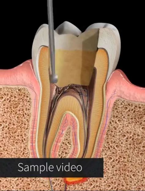 解剖学分享 | 用Complete Anatomy来看龋齿怎么治 - 哔哩哔哩专栏