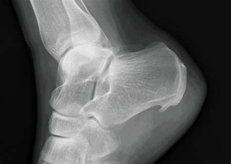 Leaders in Treating Heel Spurs | Advanced Ankle & Foot