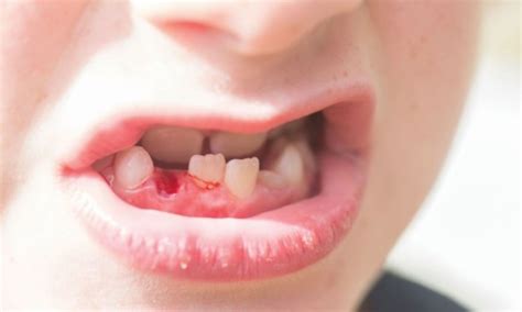 Can Simvastatin Improve Healing in Avulsed Teeth? A Case Series ...