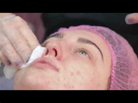 Image result for Exploding Spots