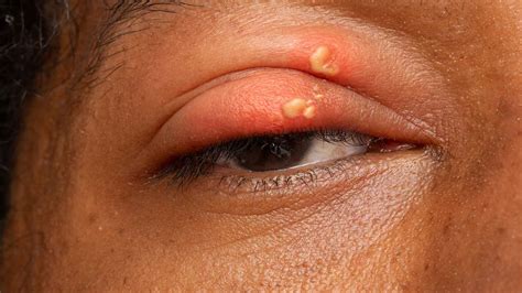 Eye Herpes Explained: London's Top Eye Clinic Guide