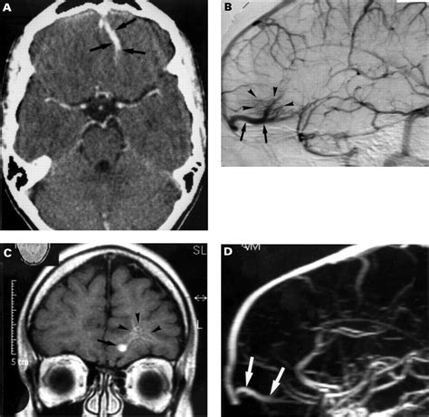 Clinical significance of intracranial developmental venous anomalies ...