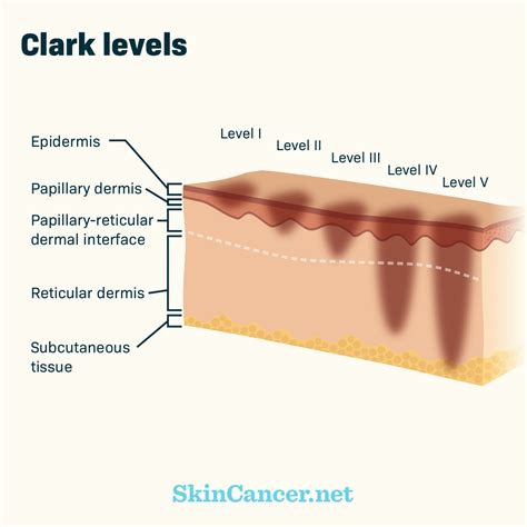 Image result for How Skin Cancer Forms