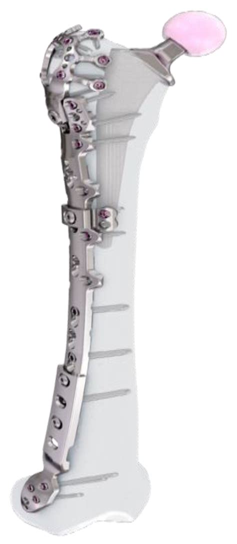 Peri- and Interprosthetic Femoral Fractures—Current Concepts and New ...