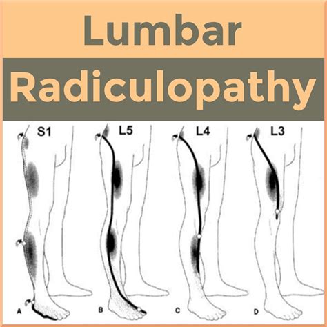 Lumbar Radiculopathy - Sports Medicine Review