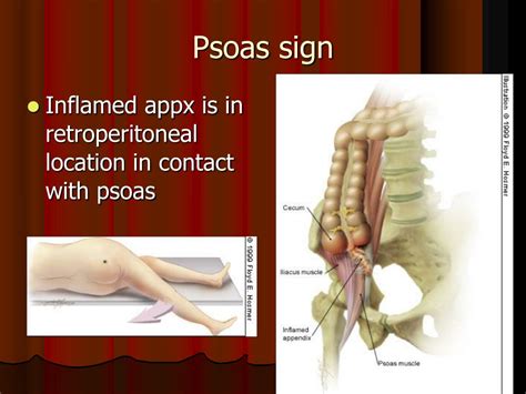 Image result for Psoas Sign Appendicitis