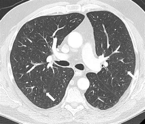 Tuberous Sclerosis Complex (TSC): Renal and Extrarenal Imaging - Academic Radiology