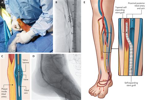 Transcatheter Arterialization of Deep Veins in Chronic Limb-Threatening ...