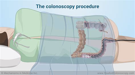 Image result for Colonoscopy Looping