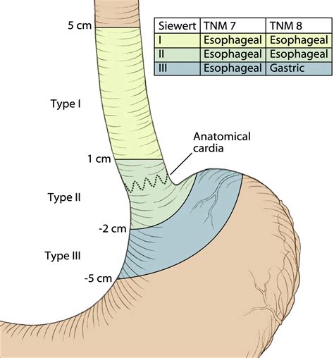 What Is the Best Operation for Proximal Gastric Cancer and Distal ...