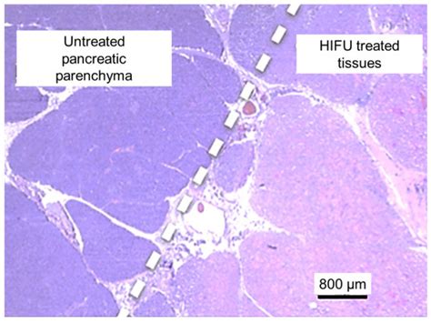 Intraoperative HIFU Ablation of the Pancreas Using a Toroidal ...
