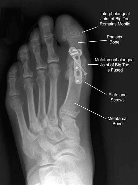 Anatomy Big Toe Big Toe Got You Down? It May Be Hallux Rigidus.
