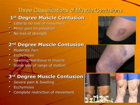 Muscle Contusion Bruise