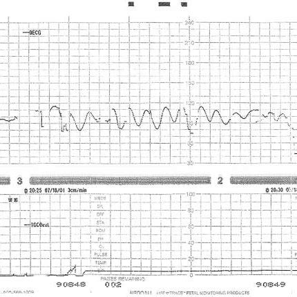 (PDF) Sinusoidal fetal heart rate pattern: Its definition and clinical ...
