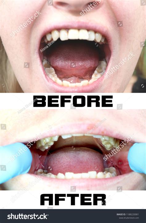 Image result for Stitches After Tooth Extraction