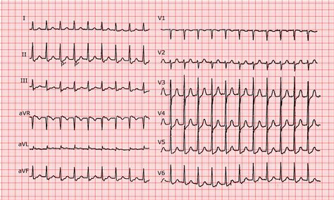 Reentrant Rhythm Definition _ Atrial Tachycardia: Symptoms, Causes ...