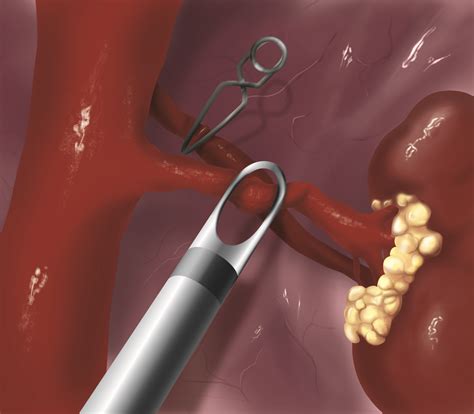 Image result for Nephrectomy Approach
