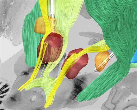 Image result for DBS Tutorial