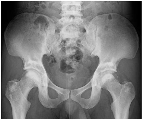 Rugger-jersey spine in osteopetrosis | BMJ Case Reports