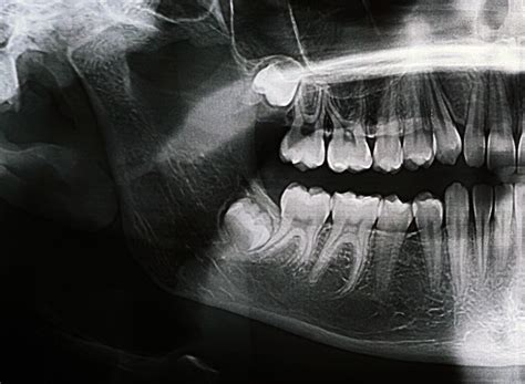 Wisdom Tooth Growing Inwards