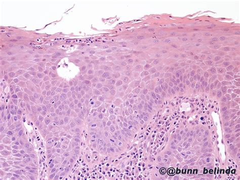Oral Candidiasis Histology