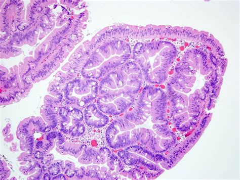 Thyroid Adenoma Histology