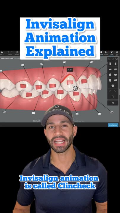 Invisalign Animation 的图像结果