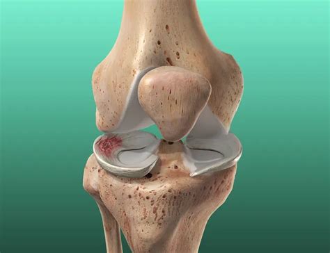 Meniscus Tear Treatment | C7Physio