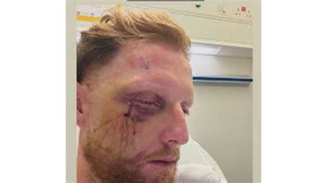 Ben Stokes undergoes successful facial surgery after cricket ball injury
