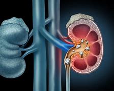 Image result for kidney stones