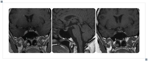 Hypopituitarism Revealing Probable Neurosarcoidosis: A Case Report and ...