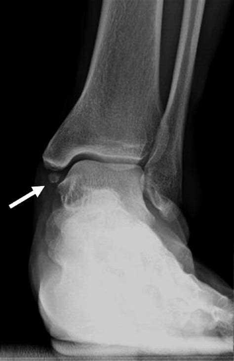 Ossicles associated with chronic pain around the malleoli of the ankle ...