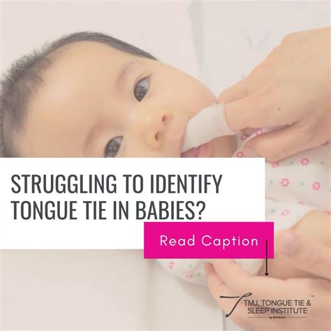 HOW TO IDENTIFY TONGUE TIE IN BABIES? Tongue-tie is a condition present at birth, It is a string ...