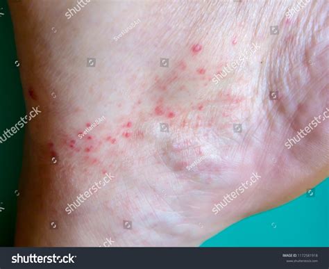 Itchy Rash Joints at Amy Heyer blog