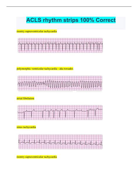 Ventricular Tachycardia Rhythm Strip