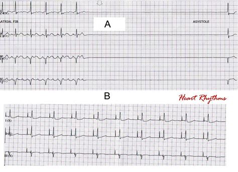 Tachy Brady Syndrome In Ecg at Douglas Jacobson blog