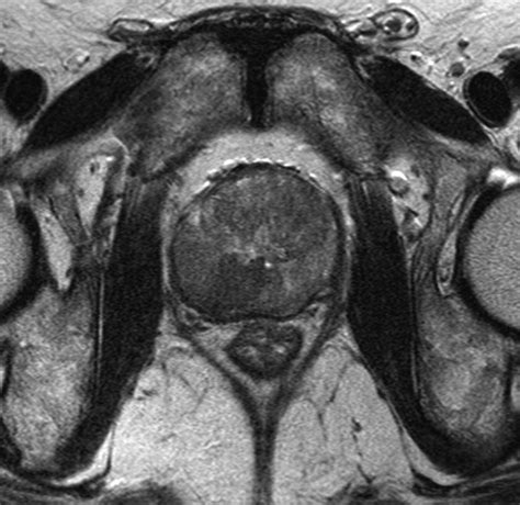 Diffusion-Weighted MRI at 3 T for the Evaluation of Prostate Cancer | AJR