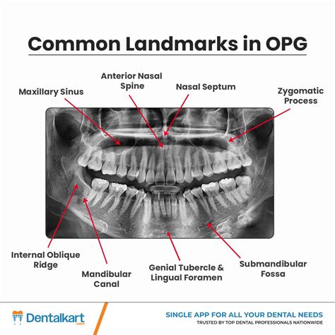 Dentalkart.com | 𝐃𝐞𝐜𝐨𝐝𝐞 𝐘𝐨𝐮𝐫 𝐎𝐏𝐆𝐬 𝐰𝐢𝐭𝐡 𝐂𝐨𝐧𝐟𝐢𝐝𝐞𝐧𝐜𝐞 Dear Doctors, Identifying key anatomical ...