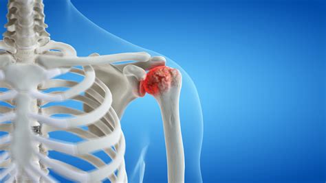 Shoulder Arthritis Signs, Symptoms & Surgery | Colorado Sports Doctor