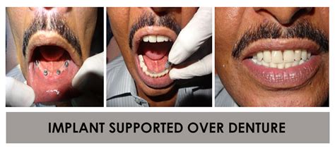 Prosthodontics - Sree Anjaneya Institute of Dental Sciences