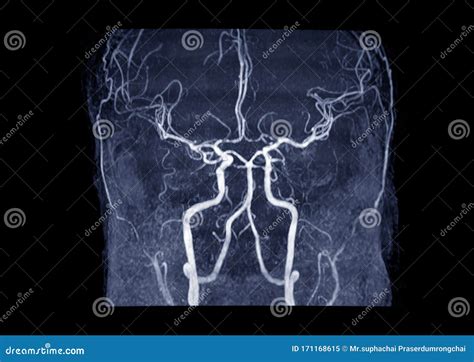 MRA Brain or Magnetic Resonance Angiography MRA of Cerebral Artery in ...