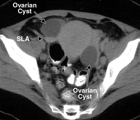 Ovarian Cyst Ct Scan