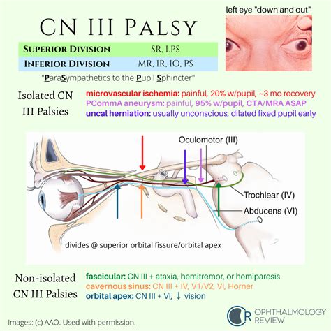 Cranial Nerve 3 Palsy