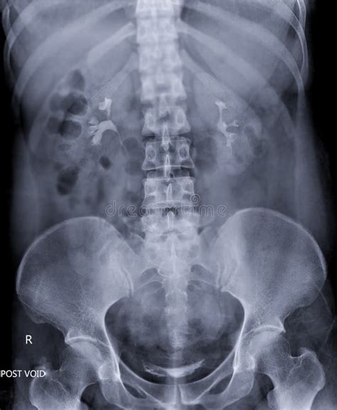Image result for Contrast Pyelogram