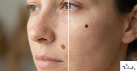How to Tell the Difference Between Beauty Marks and Moles
