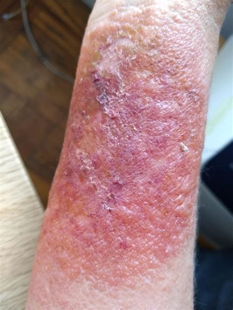 Poison Ivy Rash Looks Like A Burn at Kelly Duppstadt blog