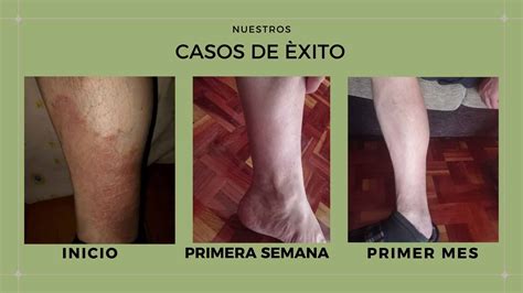 Dermatitis Por Estres Fotos