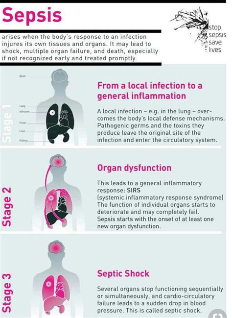 Stages Of Sepsis Nursing at Teresa Dingler blog