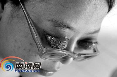 21岁女孩突患怪病眼球凸出眼外致失明(组图)_新闻中心_新浪网